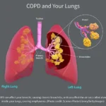COPD (Chronic Obstructive Pulmonary Disease)