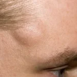 Lipoma