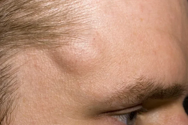 Lipoma