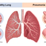 Pneumonia: What to Know