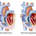 What Is Mitral Valve Regurgitation?