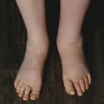 Lymphedema: What to Know