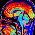 Chiari Malformation