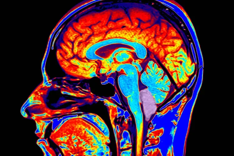 Chiari Malformation
