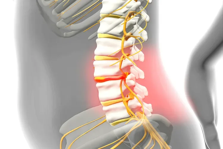 Herniated Disk: Symptoms and Diagnosis