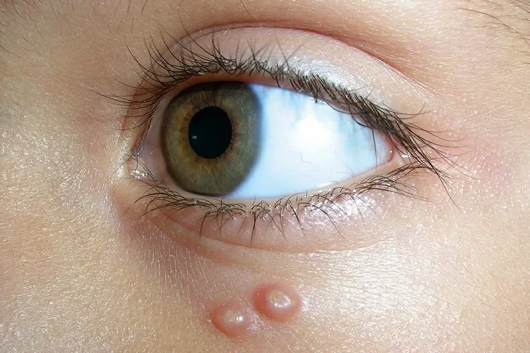 Molluscum Contagiosum