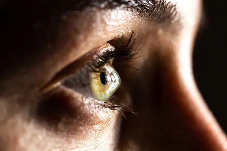 What Is Keratoconus?