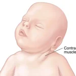 What Is Torticollis?