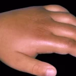 Kawasaki Disease: Symptoms and Treatment