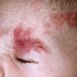 Port-Wine Stain Birthmarks