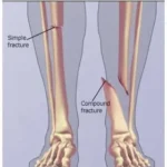 Understanding Bone Fractures -- the Basics