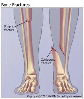 Understanding Bone Fractures -- the Basics