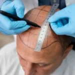 Exploring hair transplant clinics in Turkey