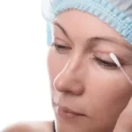 Understanding laser eyelid removal: A comprehensive guide
